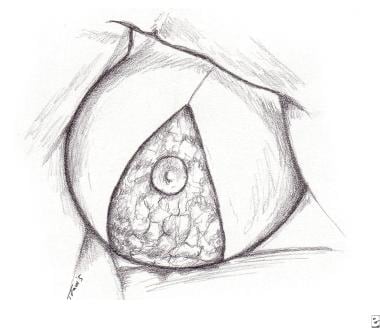 Central pedicle breast reduction. The image demons