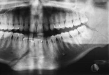 Panoramic and Towne view radiographs of right mandibu- lar angle