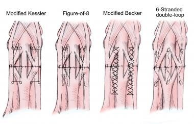 Four common core and epitenon tendon repair suture