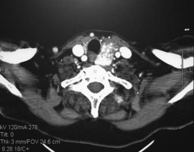 Axial CT scan of a patient with a thyroid lesion p