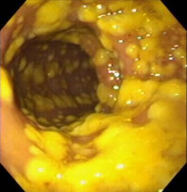 Clostridioides (Clostridium) Difficile Colitis. En