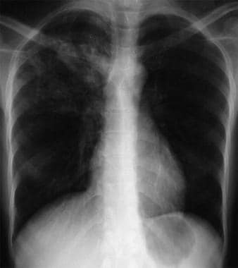 Anteroposterior chest radiograph of a young patien