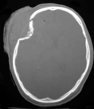 types of skull fracture