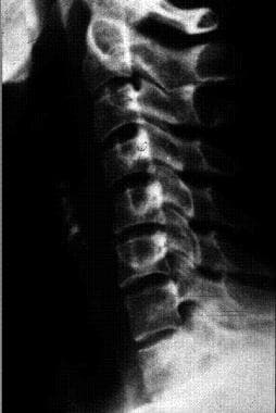 Radiograph of the lateral cervical spine shows str