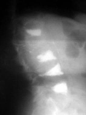 Osteoporosis. Lateral radiograph of the patient se