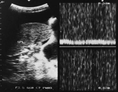 脾门多普勒超声显示肝肝