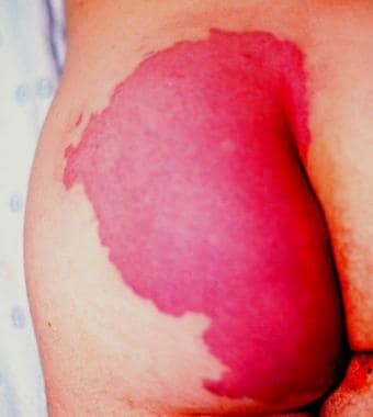 Buttock port-wine stain. 