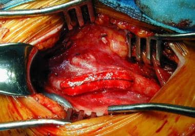 Carotid artery following Dacron patch angioplasty.