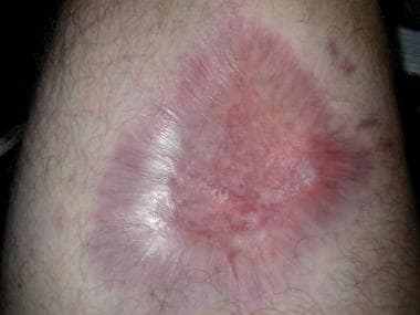 Spider bite, brown recluse. View of healed wound a