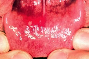 hand foot and mouth disease in mouth