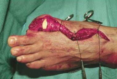 Surgical amputation of a left big toe. 