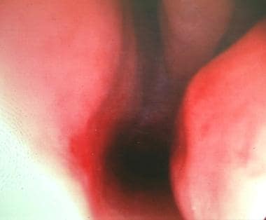 A rigid rhinoscopy photograph taken in the mid por