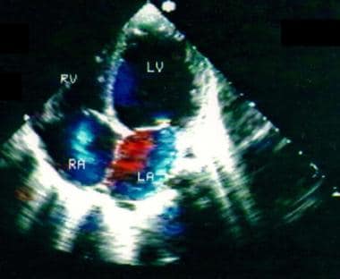 This is a color Doppler echocardiogram obtained fr