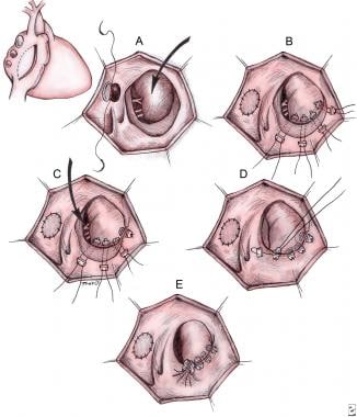 Surgical repair of Ebstein anomaly as described by