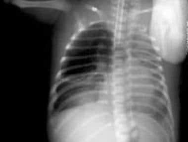 Congenital Lung Malformations. This radiograph was