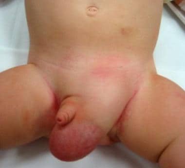 Pediatric Small Bowel Obstruction. An incarcerated