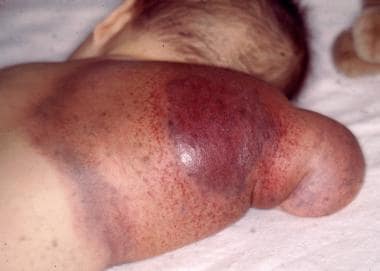 Back of an arm showing the typical bruising associ
