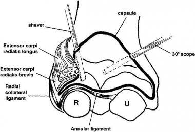 Lateral Epicondylitis: Treatment Options for an Aggravating Diagnosis