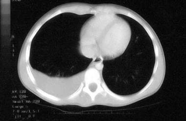 Malignant pleural effusion. Non-Hodgkin lymphoma o