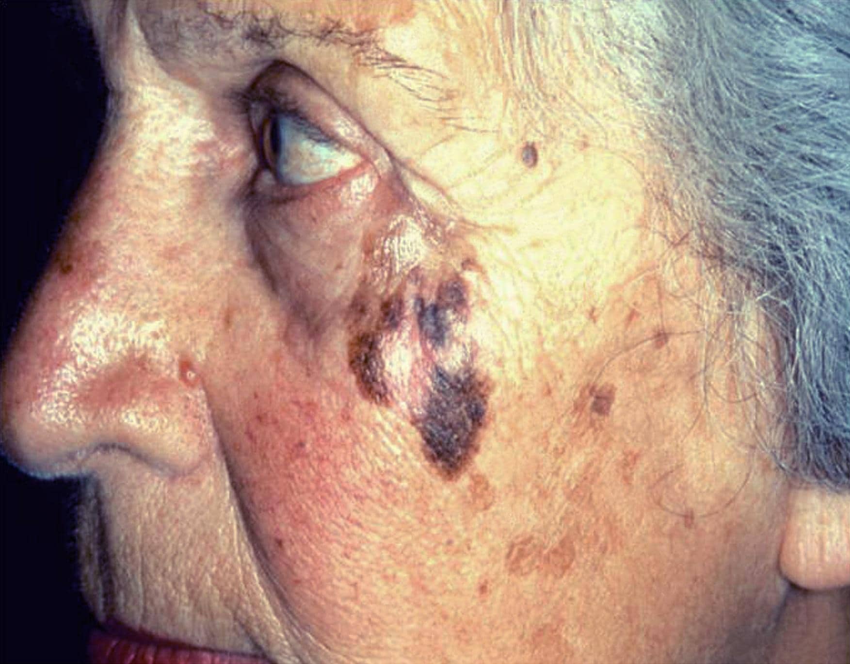 Lentigo maligna melanoması