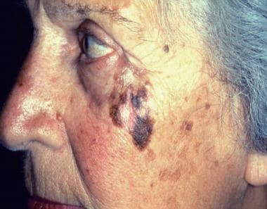 Photograph shows lentigo maligna melanoma on a pat