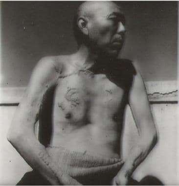 Japanese man with injuries after atomic bombing. C