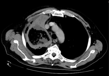 CT of AML patient with a fungal pneumonia in the r