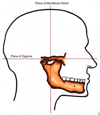 下颌骨切迹和颧骨平面的侧位图
