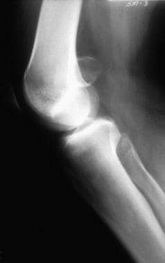 Lateral radiograph of a distal femoral periosteal 