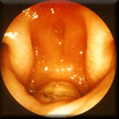 Postoperative nasoendoscopic view of velopharynx, 
