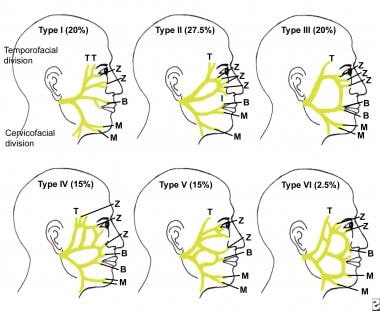 Motor points of face for electrical stimulation of bell's palsy