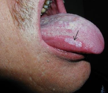 Black Lesion In Mouth 58