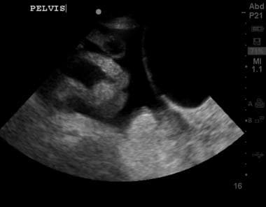 Abdominal ultrasound showing ascites fluid (dark) 