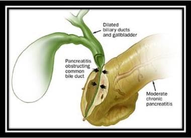 Biliary obstruction secondary to chronic pancreati