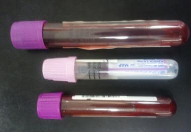 Full blood count Vacutainer. 