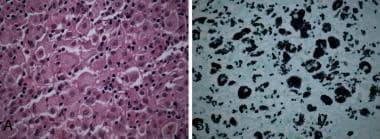 A and B) H&E and GMS stain of disseminated form of