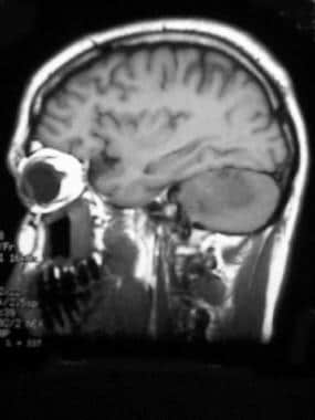 Medulloblastoma in a 27-year-old man. Nonenhanced 