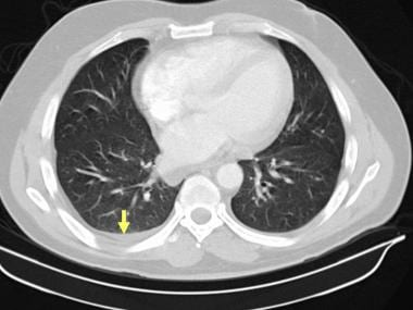 Lung window of a computed tomography scan in a 50-