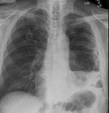 Posteroanterior chest radiograph in a patient with