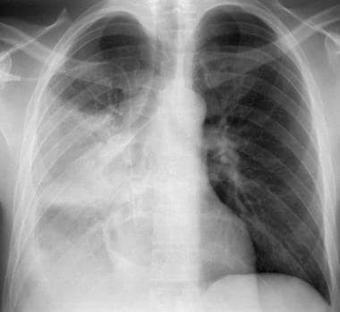 Posteroanterior chest radiograph in a young patien