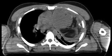 Thymolipoma. CT scan of the chest shows a large an