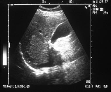 Longitudinal sonogram through the liver and gallbl