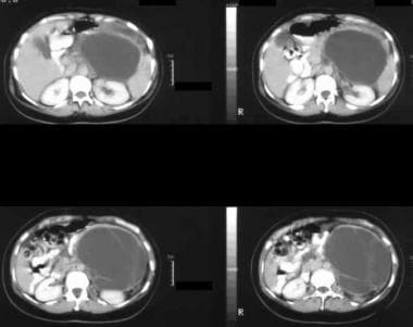 Enhanced axial CT scans show a large septate mass 
