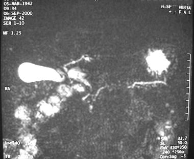 Magnetic resonance cholangiopancreatogram of a pan