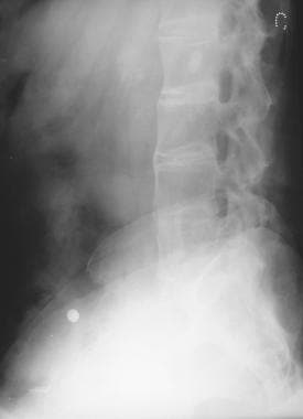 Lateral radiograph of the lumbar spine shows a bam