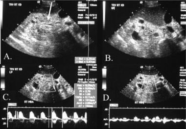 Renal sonography of a patient with a renal transpl