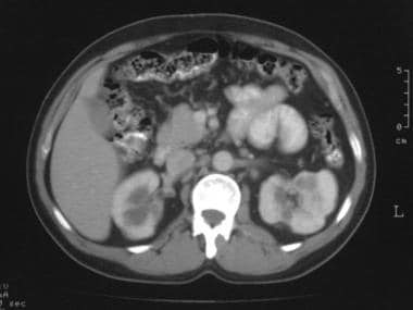 Computed tomography image of the kidney obtained i