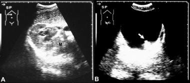 Left, transverse sonogram of the right kidney in t