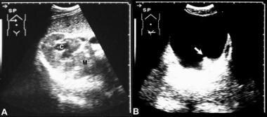 Left, transverse sonogram of the right kidney in t