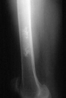Radiograph of the right femur demonstrates a calci